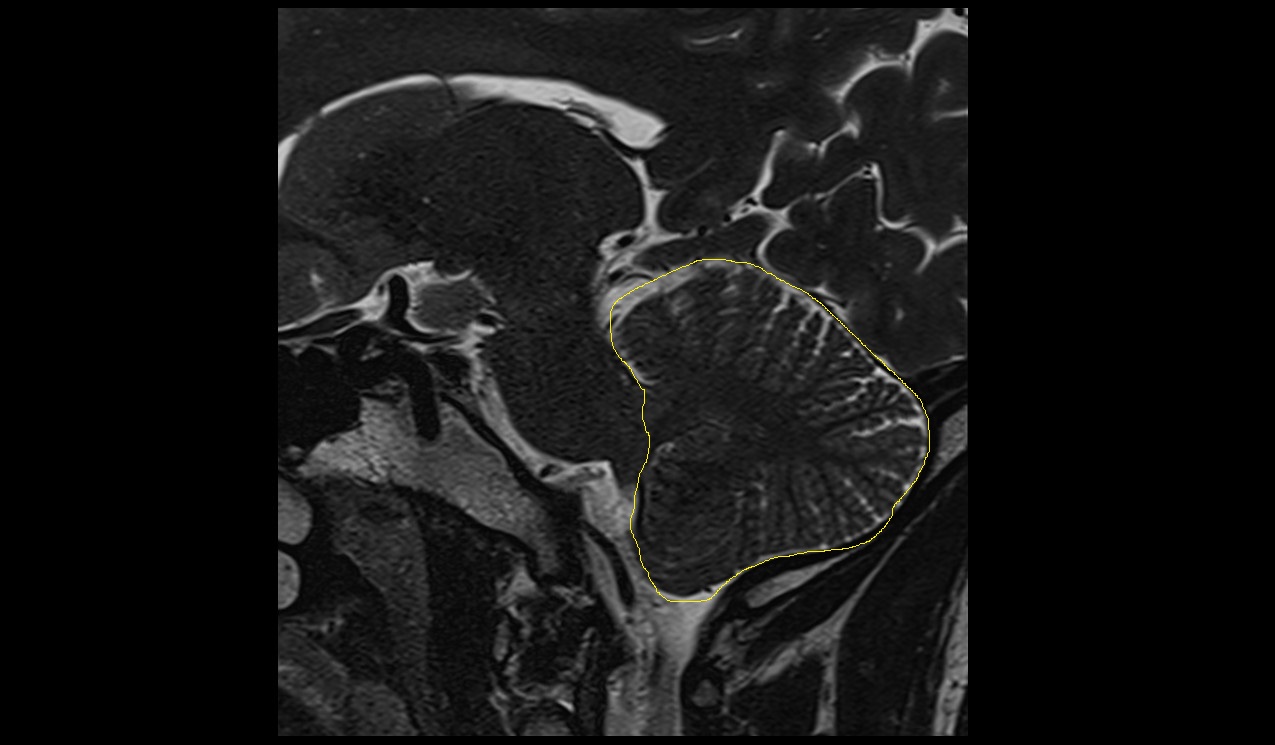 Cerebellum MRI 3T sagittal image