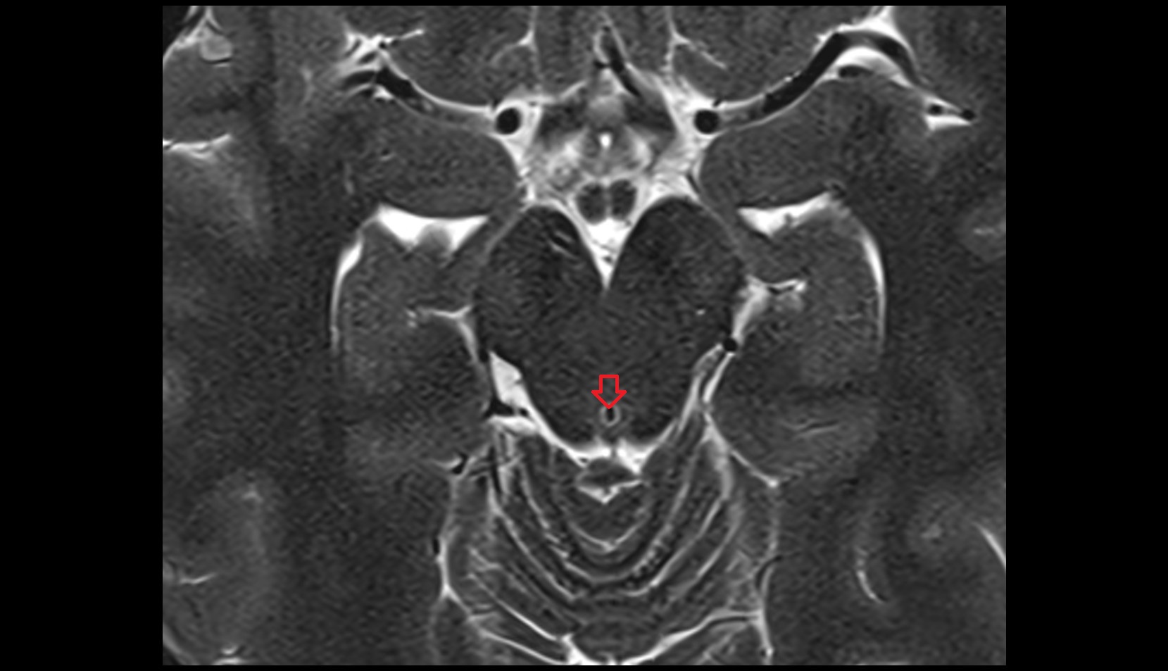 Cerebral aqueduct (Sylvian aqueduct) mri axial image