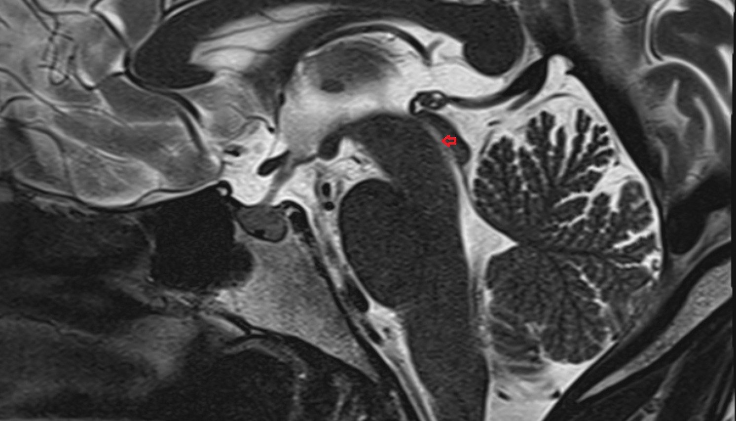 Cerebral aqueduct (Sylvian aqueduct)  mri sag  image -img-00000-00000