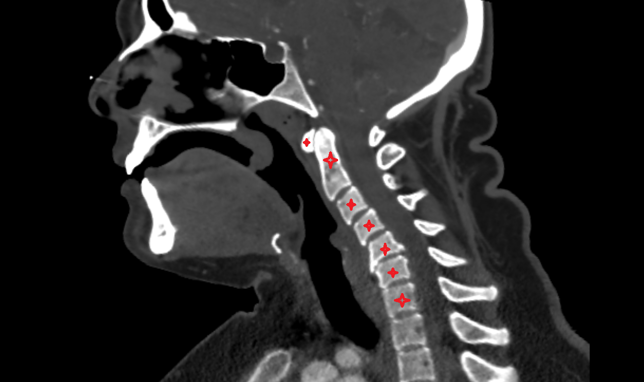 Cervical Spine ct  anatomy  Location and Imaging Appearance  -img-00000-00000