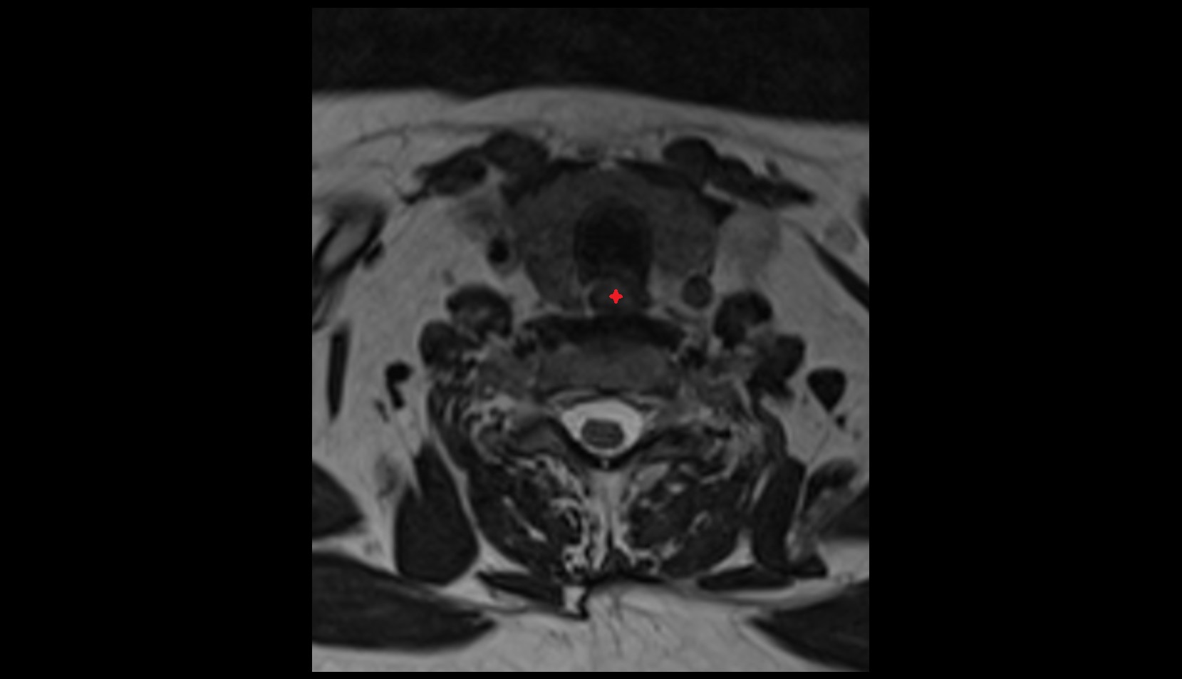 Cervical part of esophagus