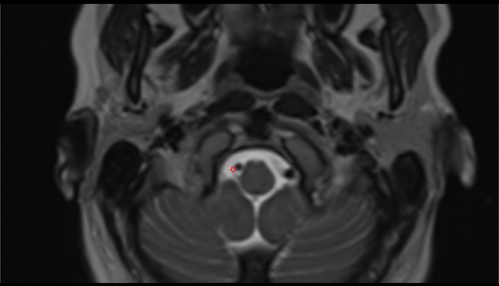 Cervical spinal nerve 1 (C1) MRI axial t2 image