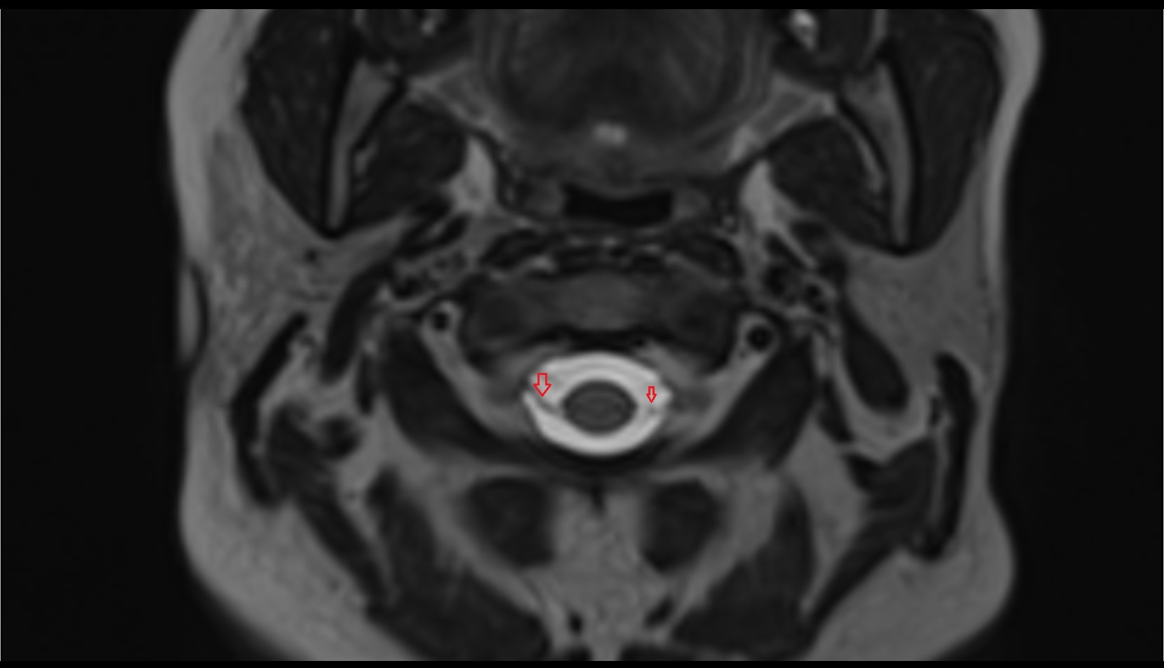Cervical spinal nerve 2 (C2) MRI axial t2 image