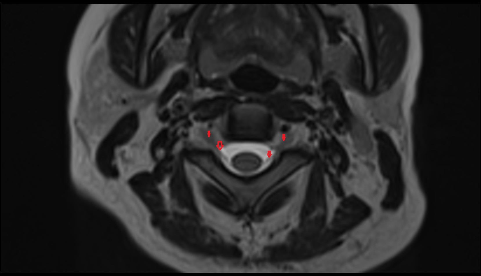 Cervical spinal nerve 3 (C3) MRI axial t2 image