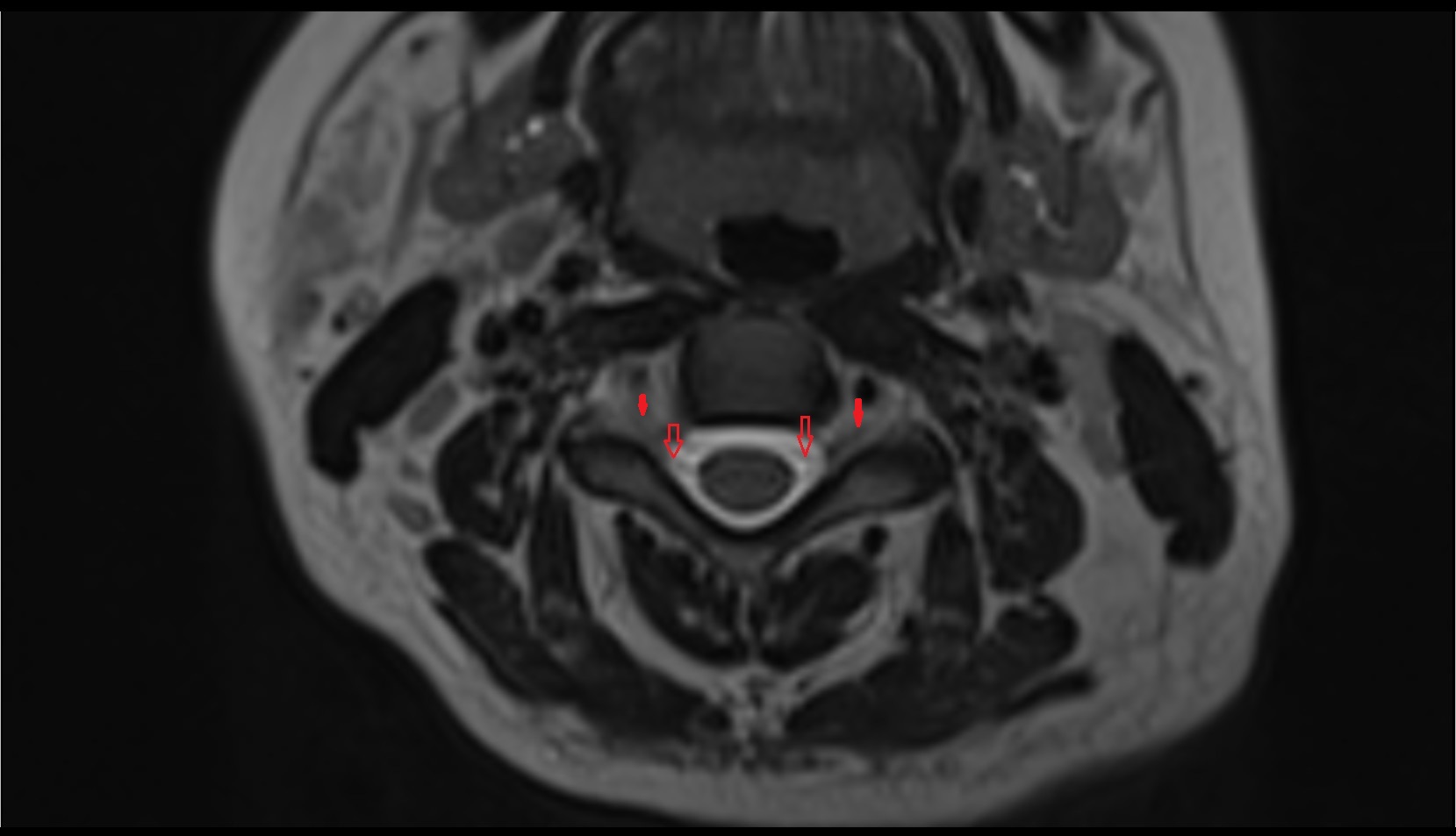 Cervical spinal nerve 4 (C4) MRI axial t2 image