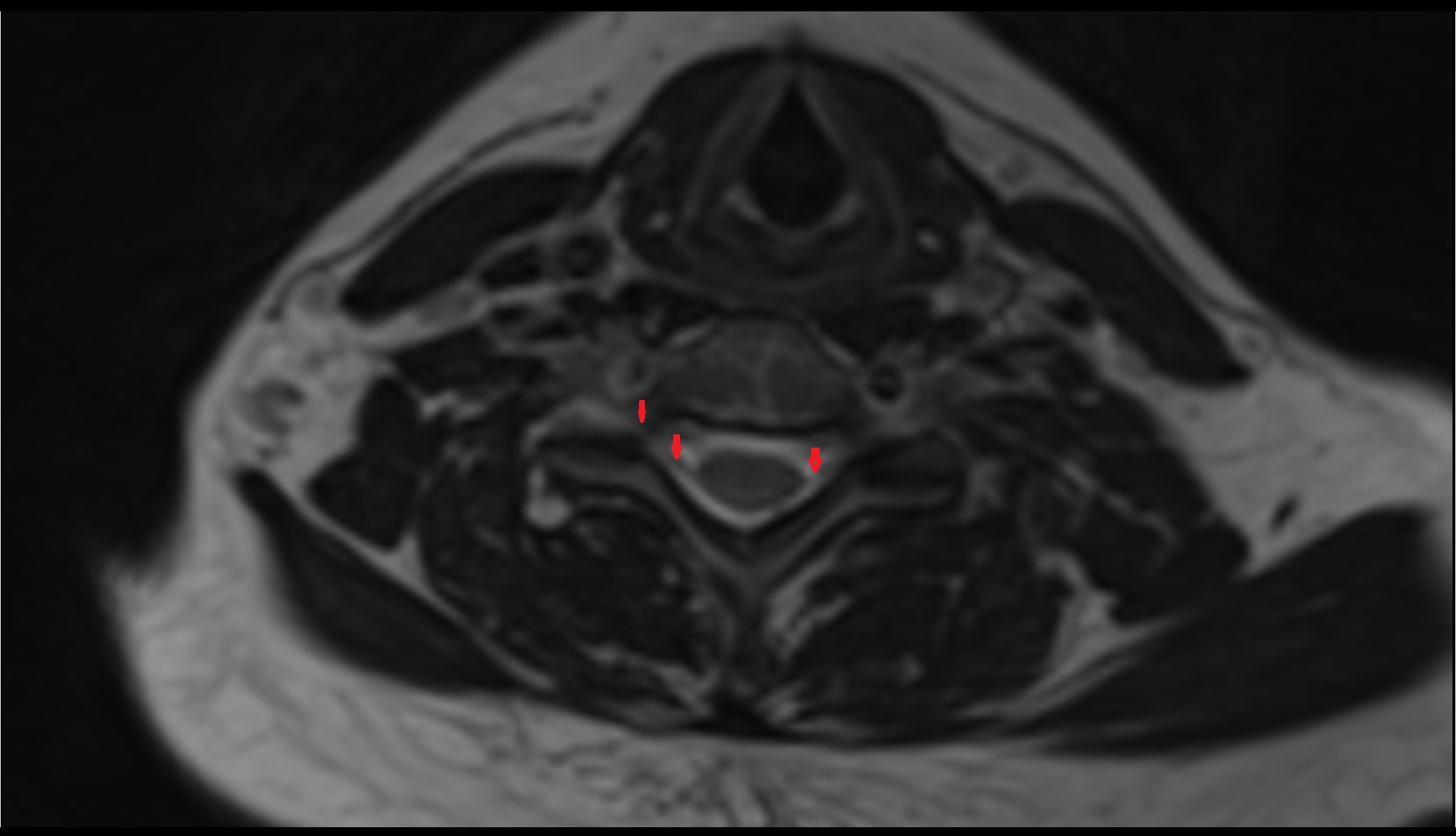 Cervical spinal nerve 7 (C7) MRI axial t2 image