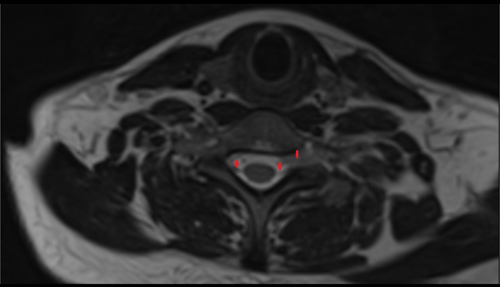Cervical spinal nerve 8 (C2) MRI axial t2 image