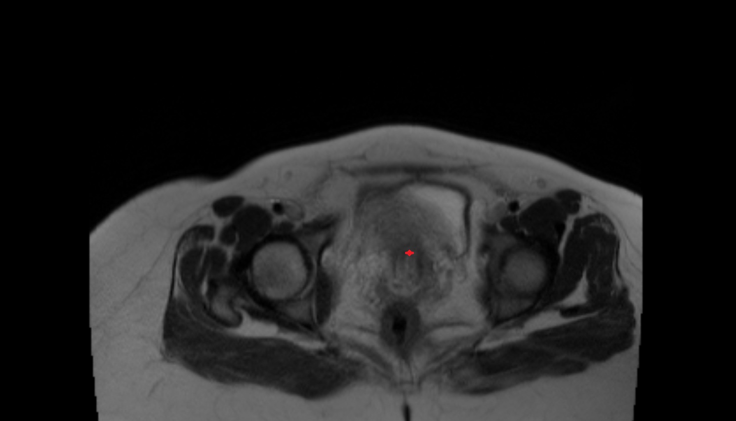 Cervix in Pregnancy  MRI axial  anatomy image-img-00000-00000