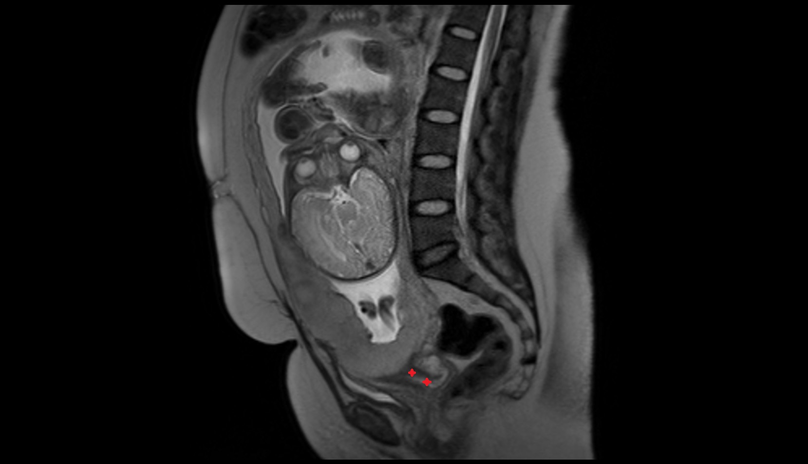Cervix in Pregnancy mri sagittal image