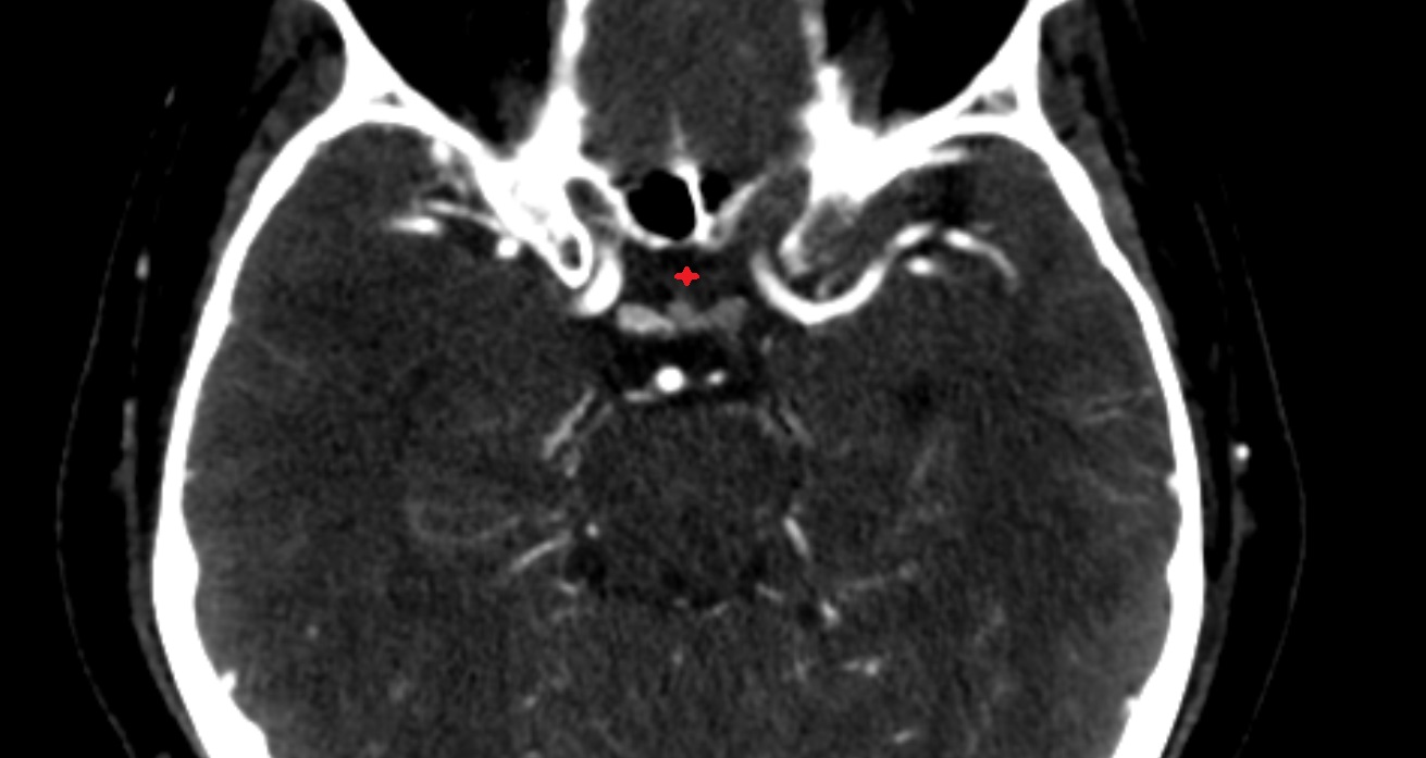 Chiasmatic cistern  CT axial anatomy image -img-00001-00001
