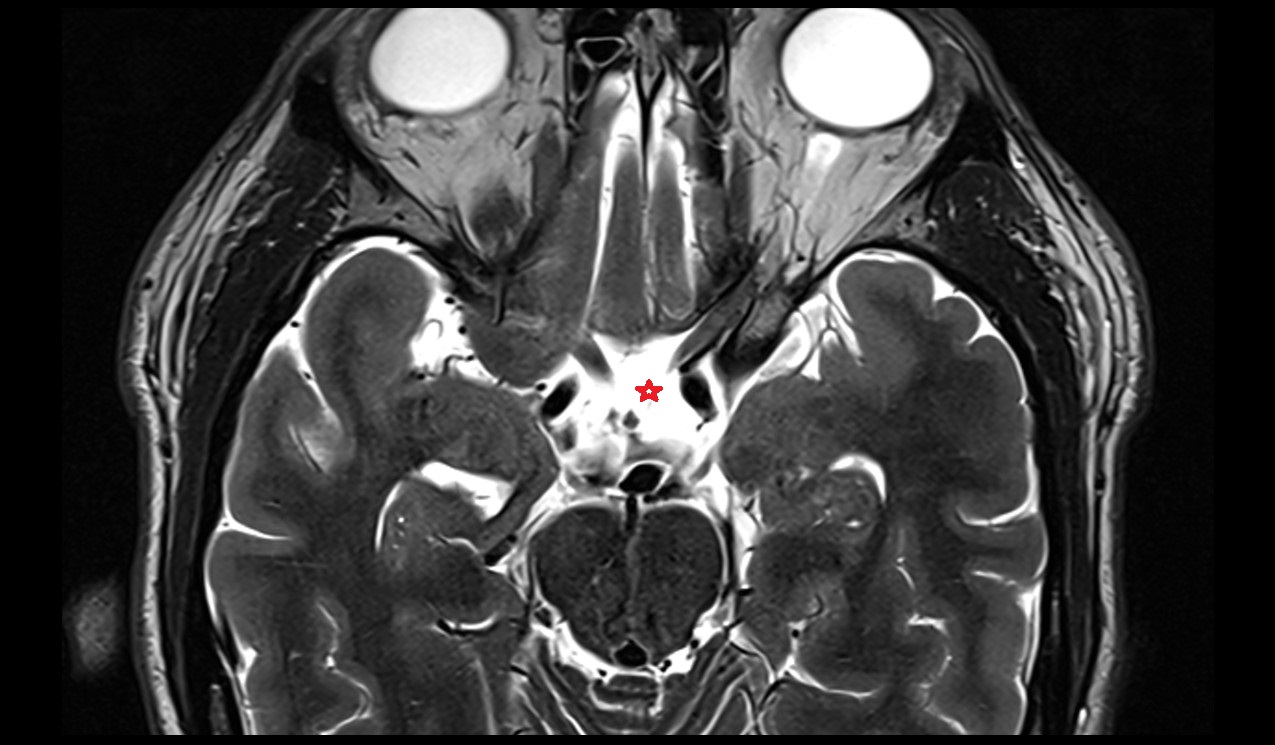 Chiasmatic cistern mri 3t axial image