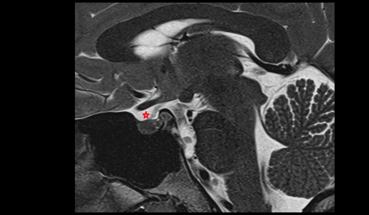 Chiasmatic cistern mri 3t sagittal image