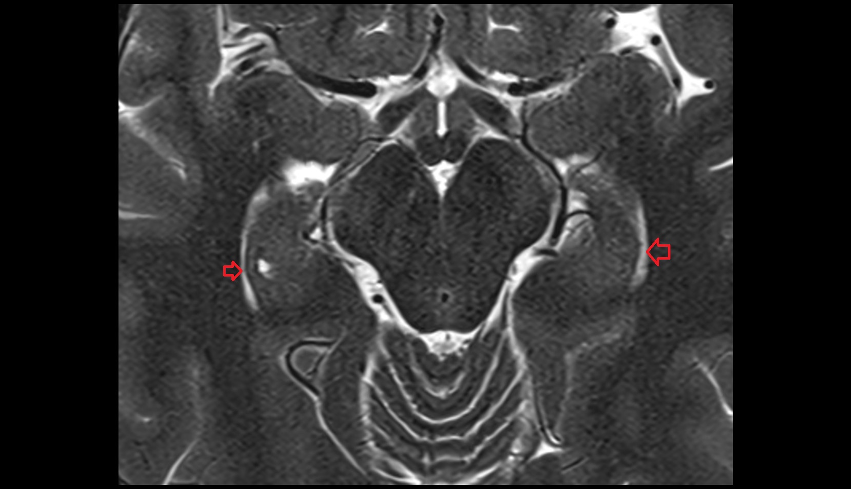 Choroid fissure axial mri image