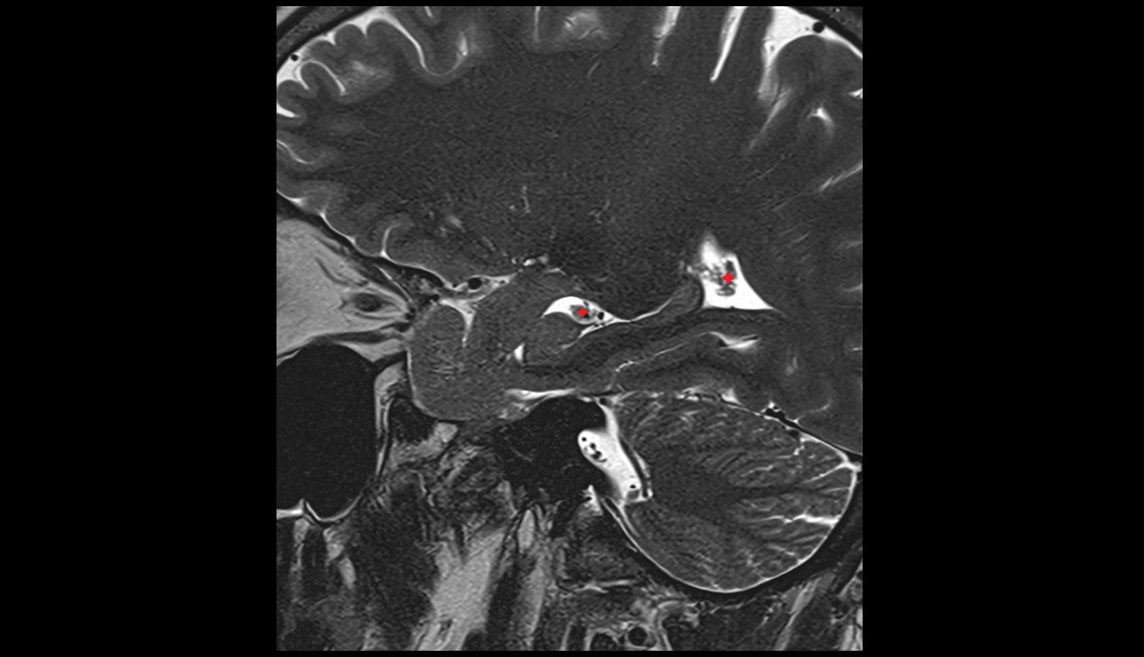 Choroid plexus MRI sagittal image