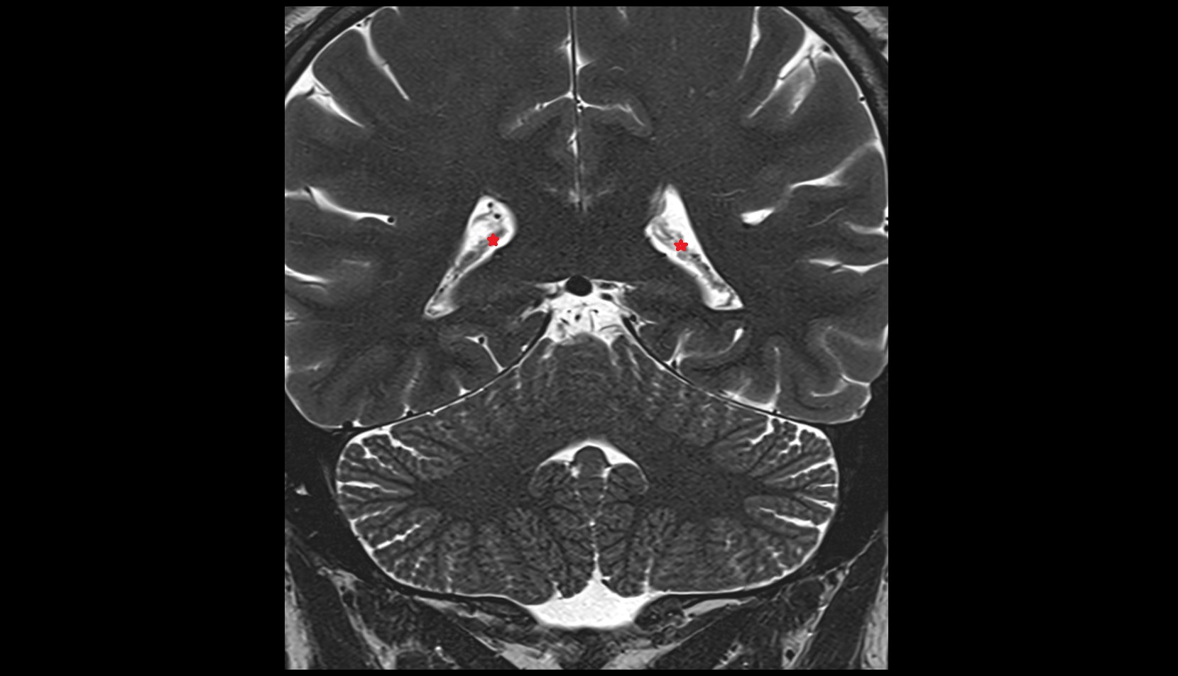 Choroid plexus coronal