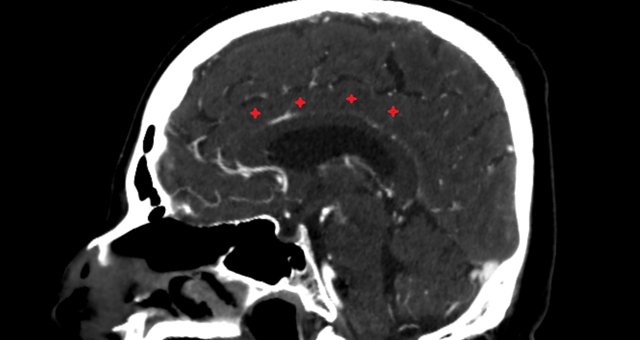 Cingulate gyrus  CT sagittal anatomy image -img-00001-00001