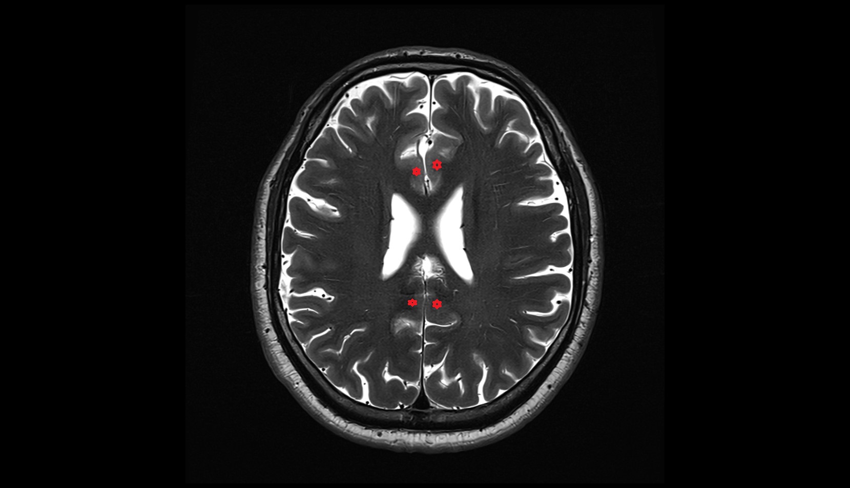Cingulate gyrus MRI 3T axial image