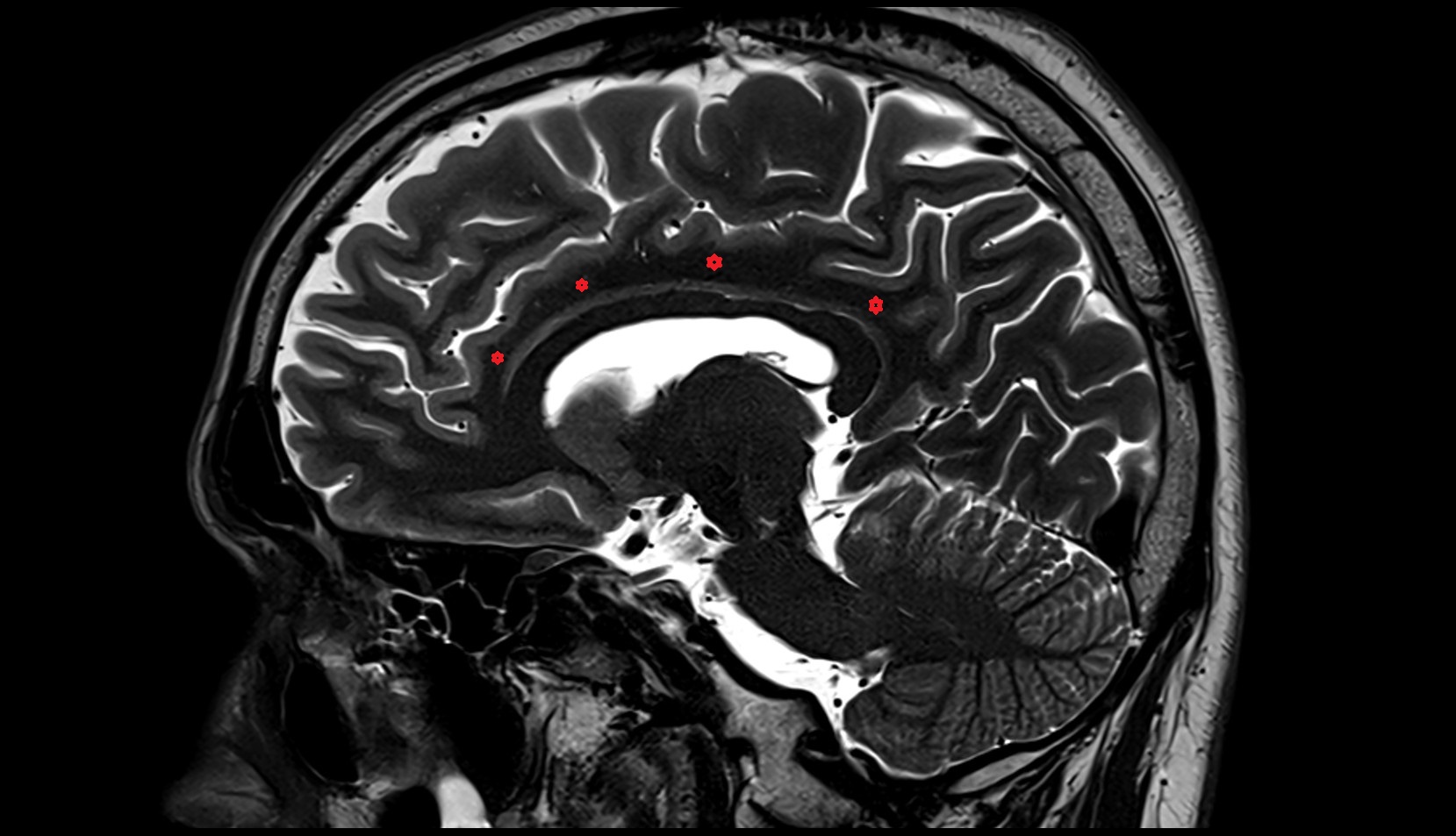 Cingulate gyrus MRI 3T sagittal image