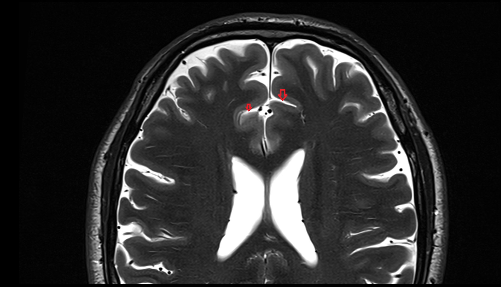 Cingulate sulcus MRI 3T axial image