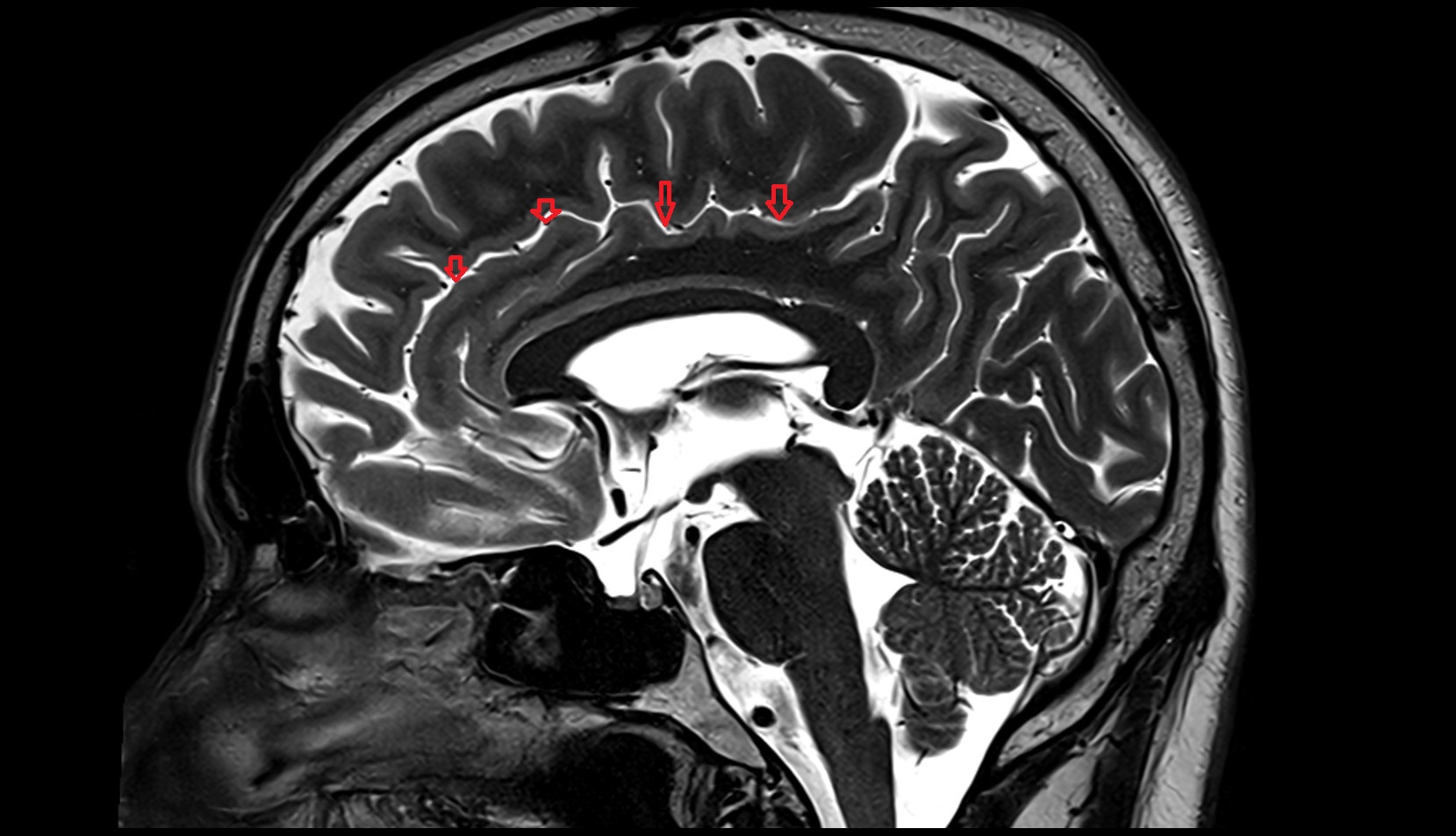 Cingulate sulcus MRI 3T sagittal image