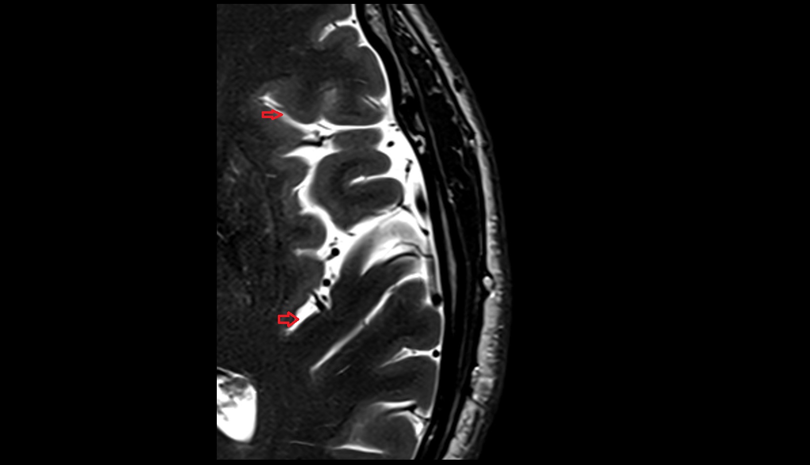 Circular sulcus of insula MRI 3T AXIAL IMAGE