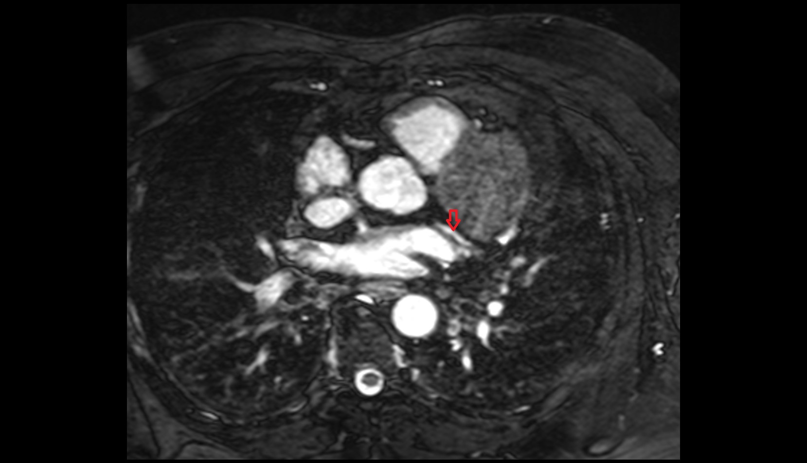 Circumflex artery (LCx) MRI axial image