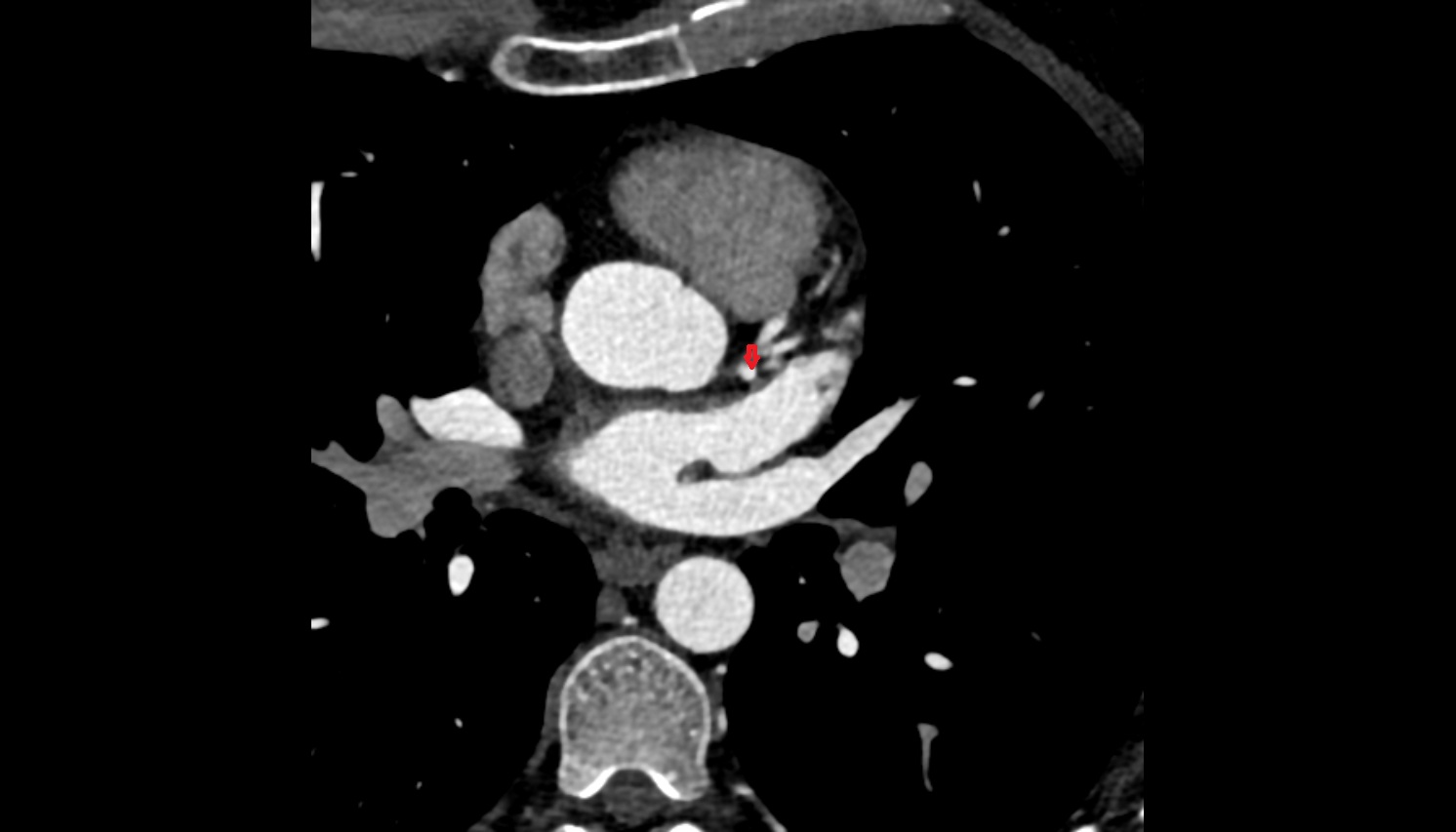 Circumflex artery (LCx)    anantomy  CT  axial image -img-00000-00000