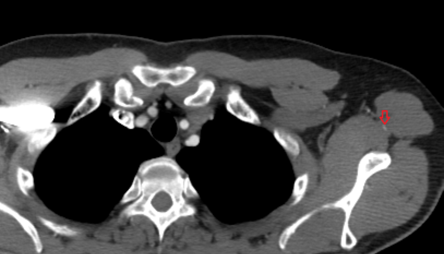 Circumflex scapular artery  anatomy CT axial  image -img-00000-00000