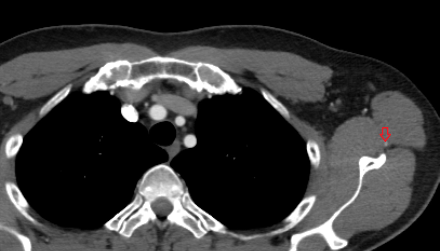 Circumflex scapular artery  anatomy CT axial  image -img-00000-00000_00001