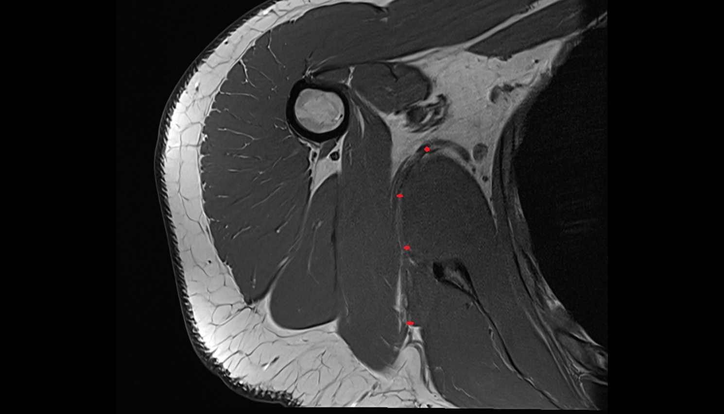 Circumflex subscapular artery  axial cross sectional anatomy 3T MRI AI enhanced radiology image-img-00000-00000