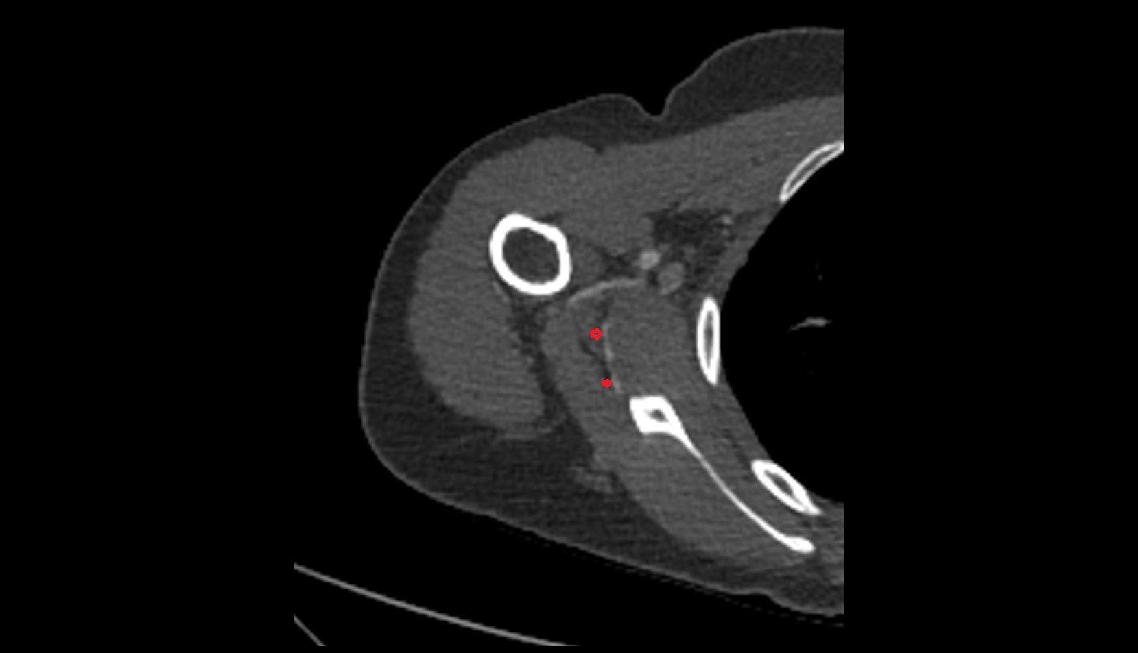 Circumflex subscapular artery ct axial image