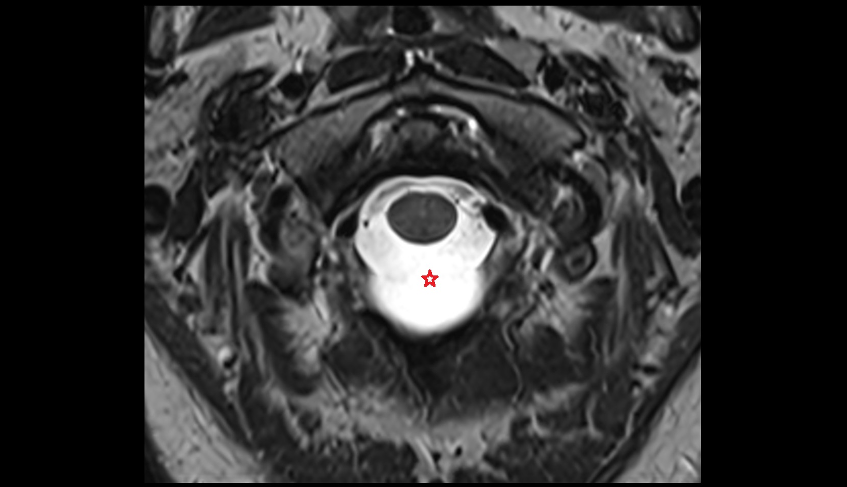 Cisterna magna mri axial image