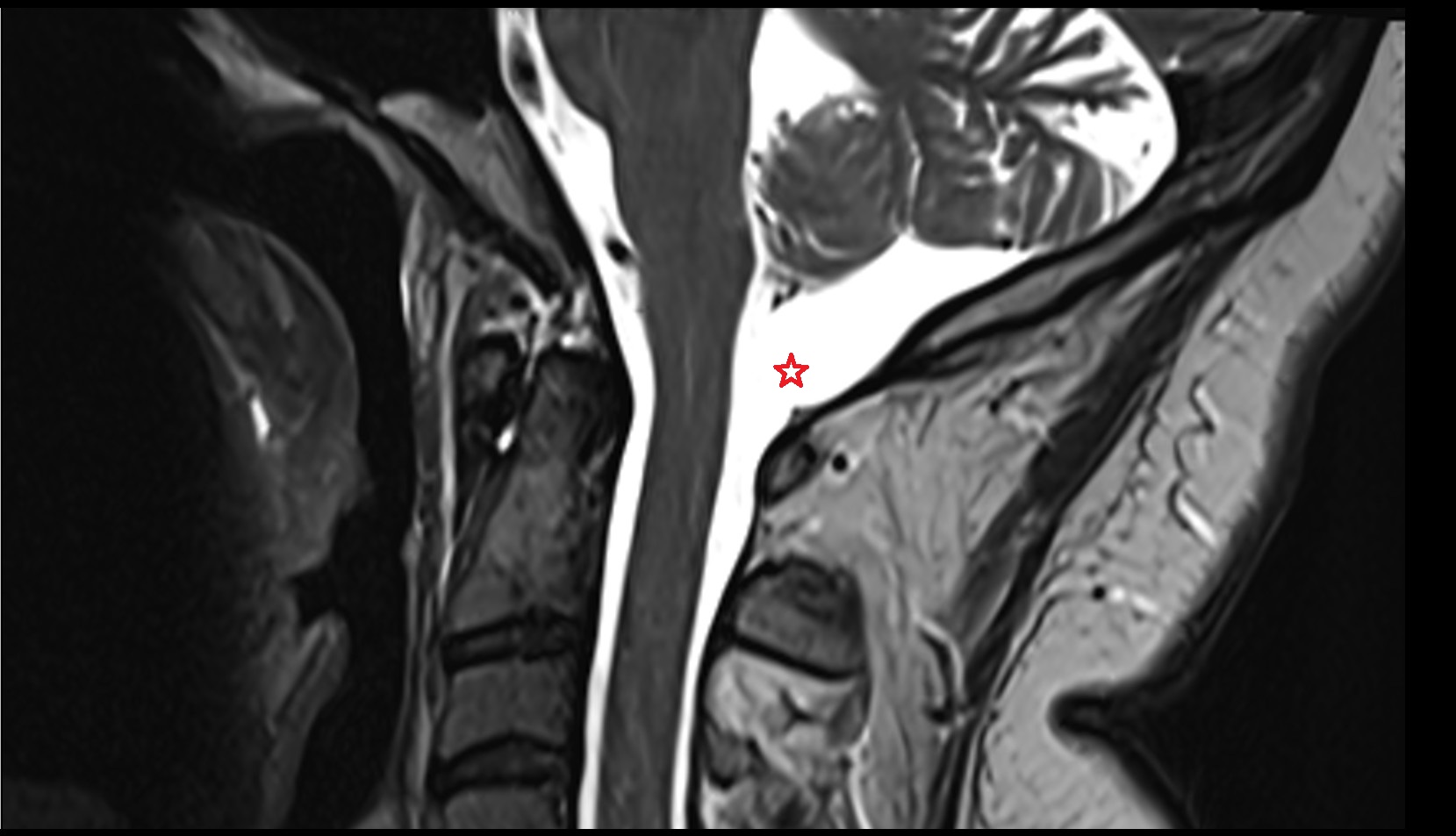 Cisterna magna mri sagittal image
