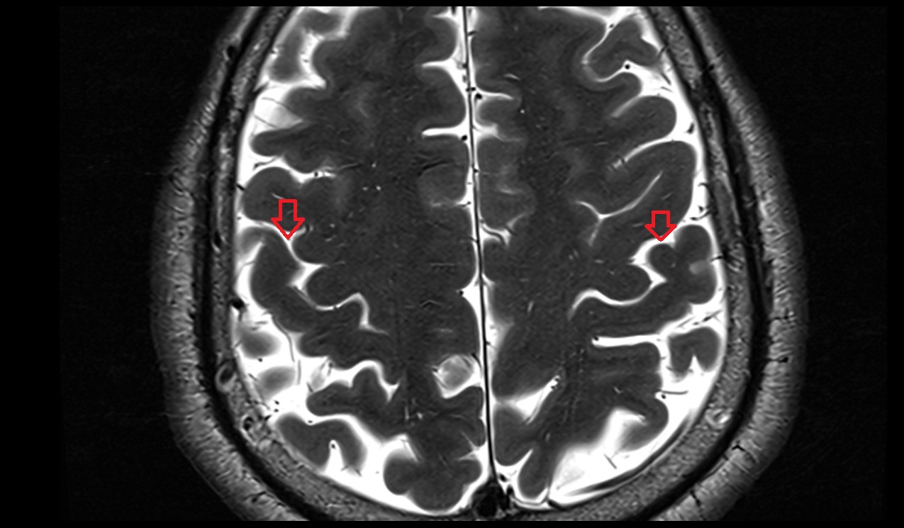 Cistern of central sulcus mri 3t axial image