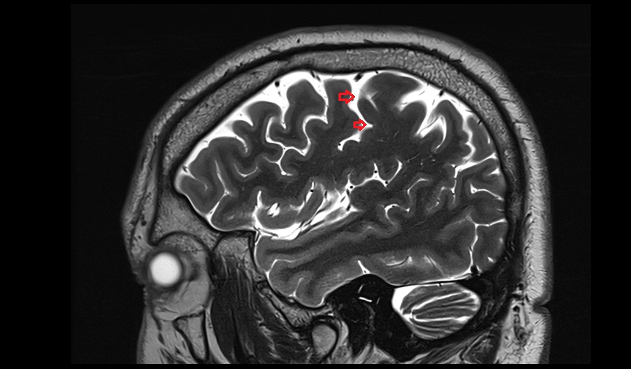 Cistern of central sulcus mri 3t sagittal image