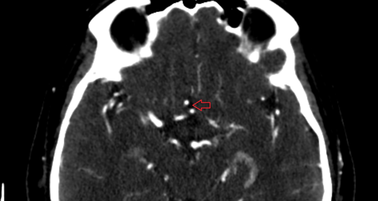 Cistern of lamina terminalis  CT axial anatomy image -img-00001-00001