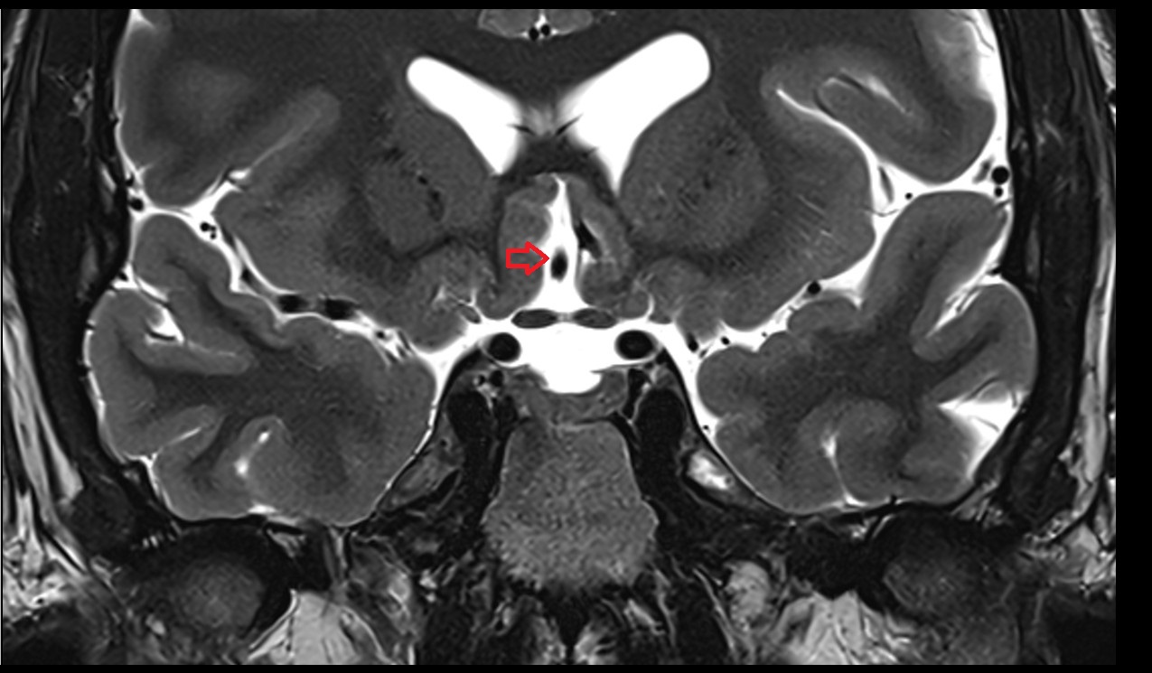 Cistern of lamina terminalis mri 3t coronal image