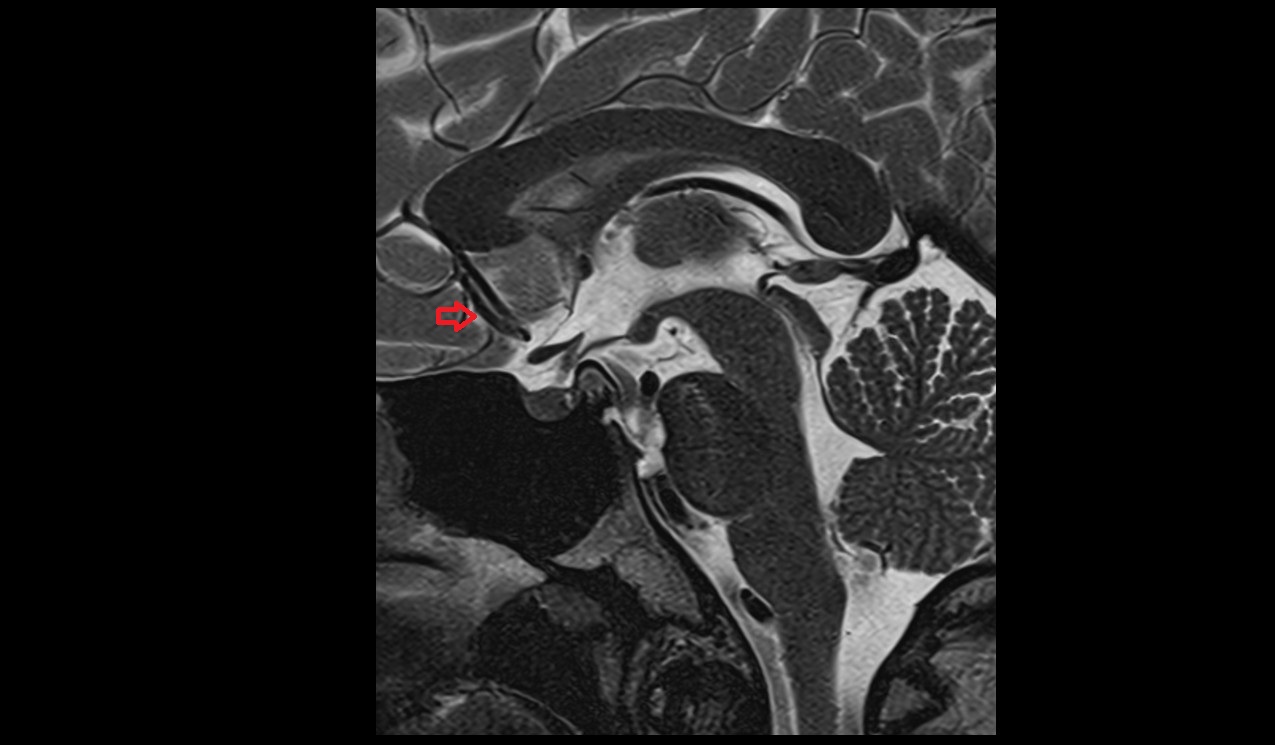 Cistern of lamina terminalis mri 3t sagittal image