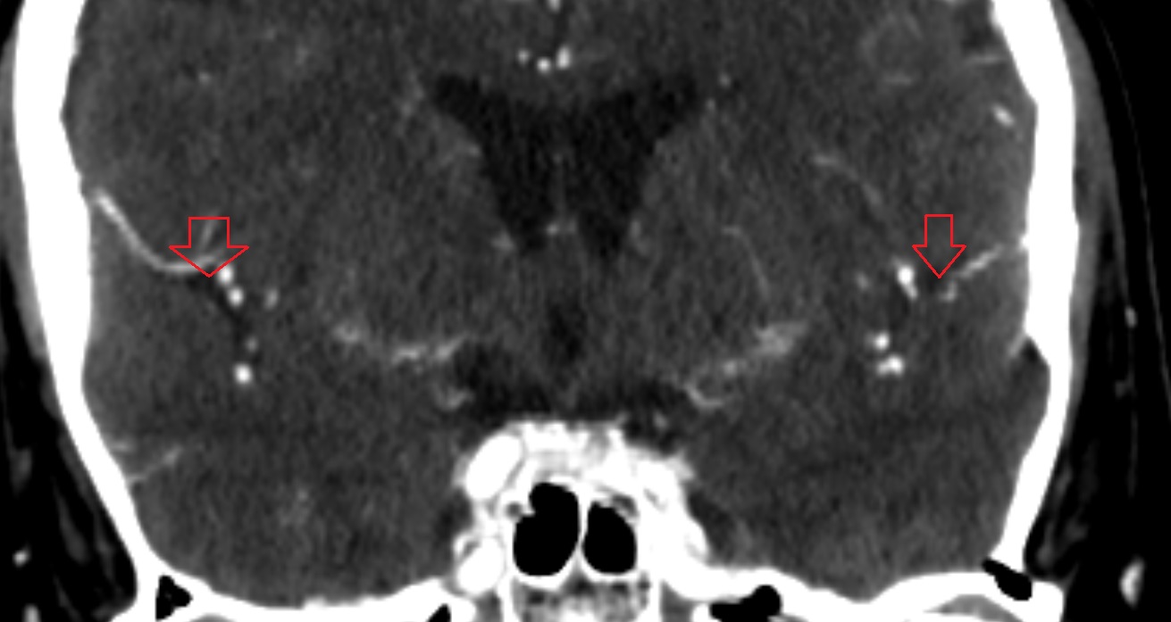 Cistern of lateral cerebral fossa (Sylvian cistern)  CT axial anatomy image -img-00001-00001