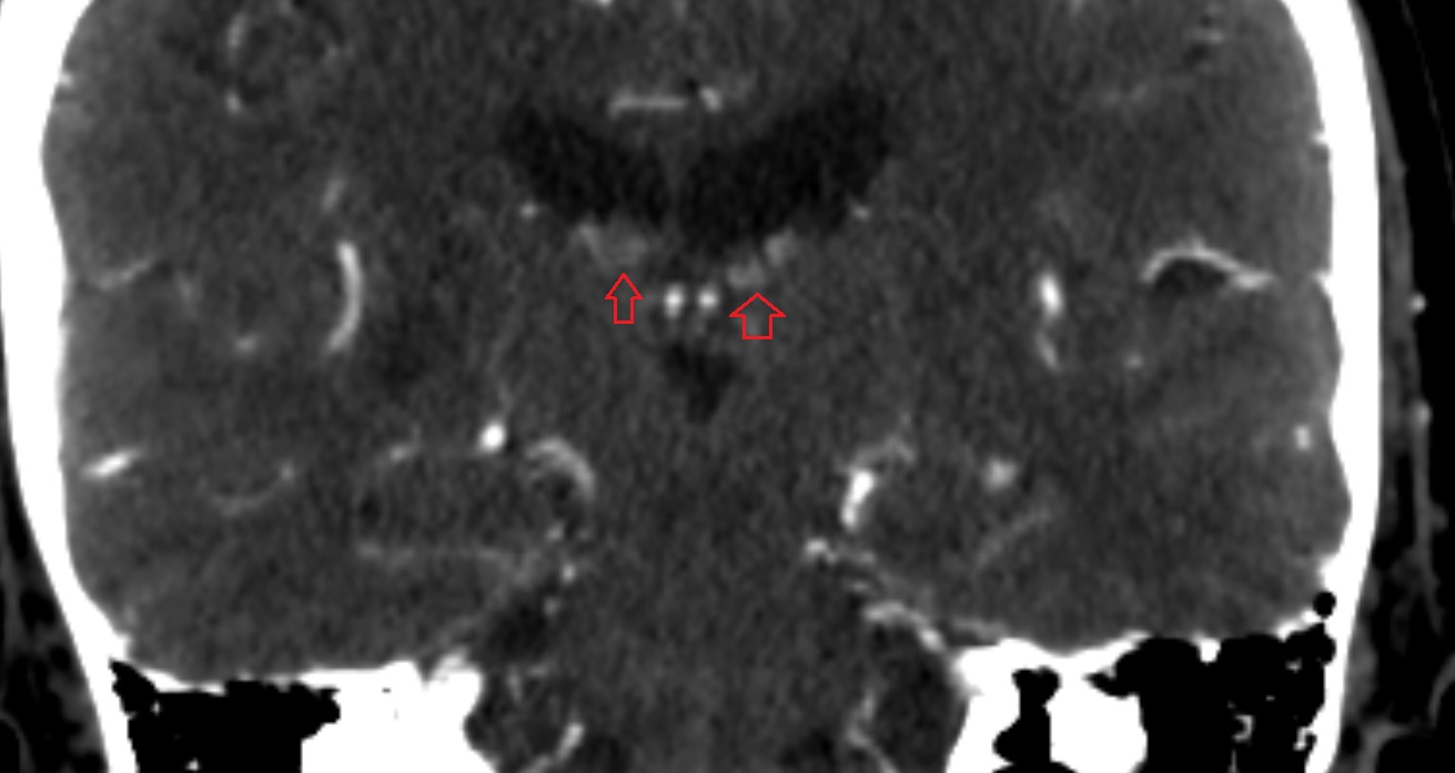 Cistern of transverse fissure  CT axial anatomy image -img-00001-00001