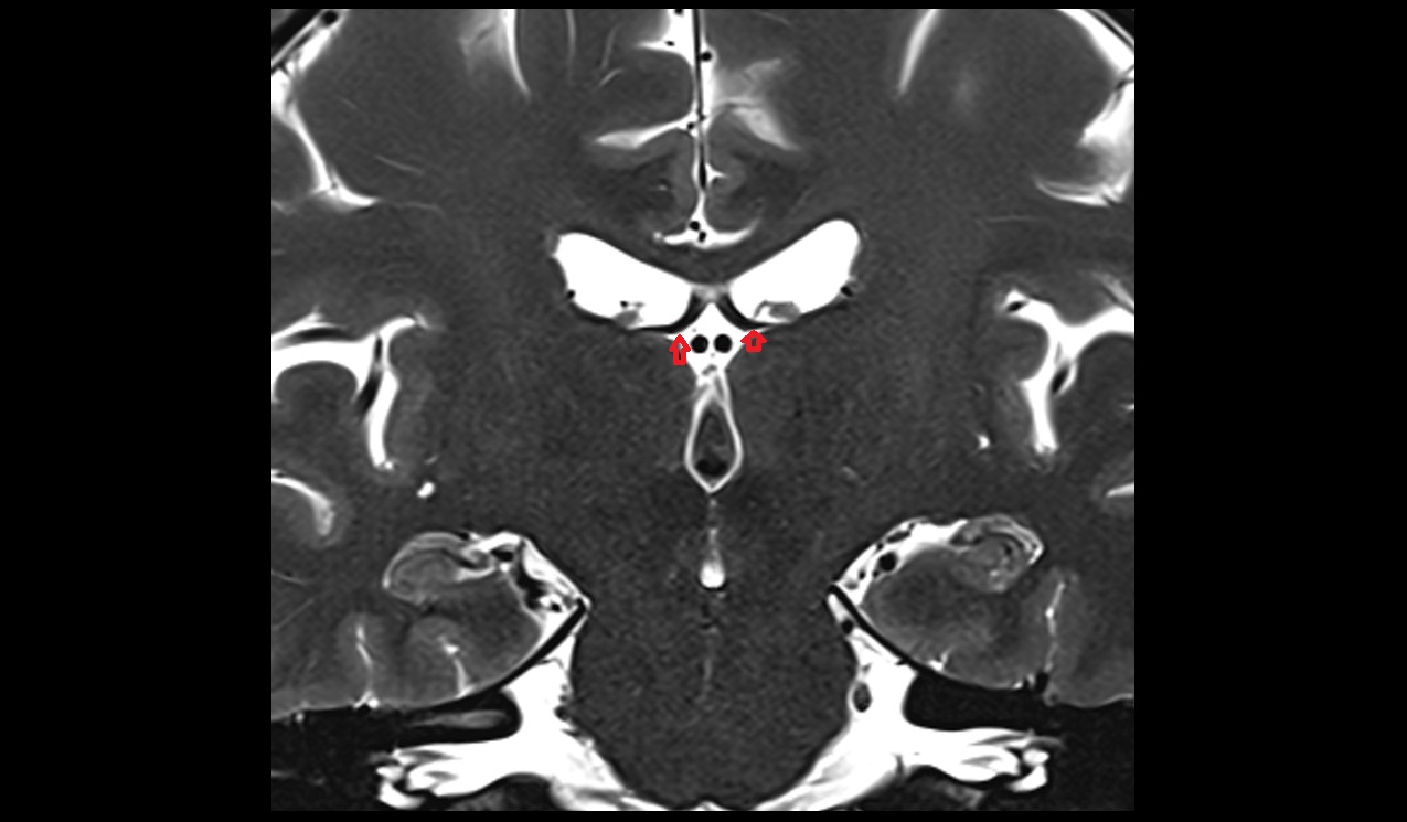 Cistern of transverse fissure mri 3t  coronal image