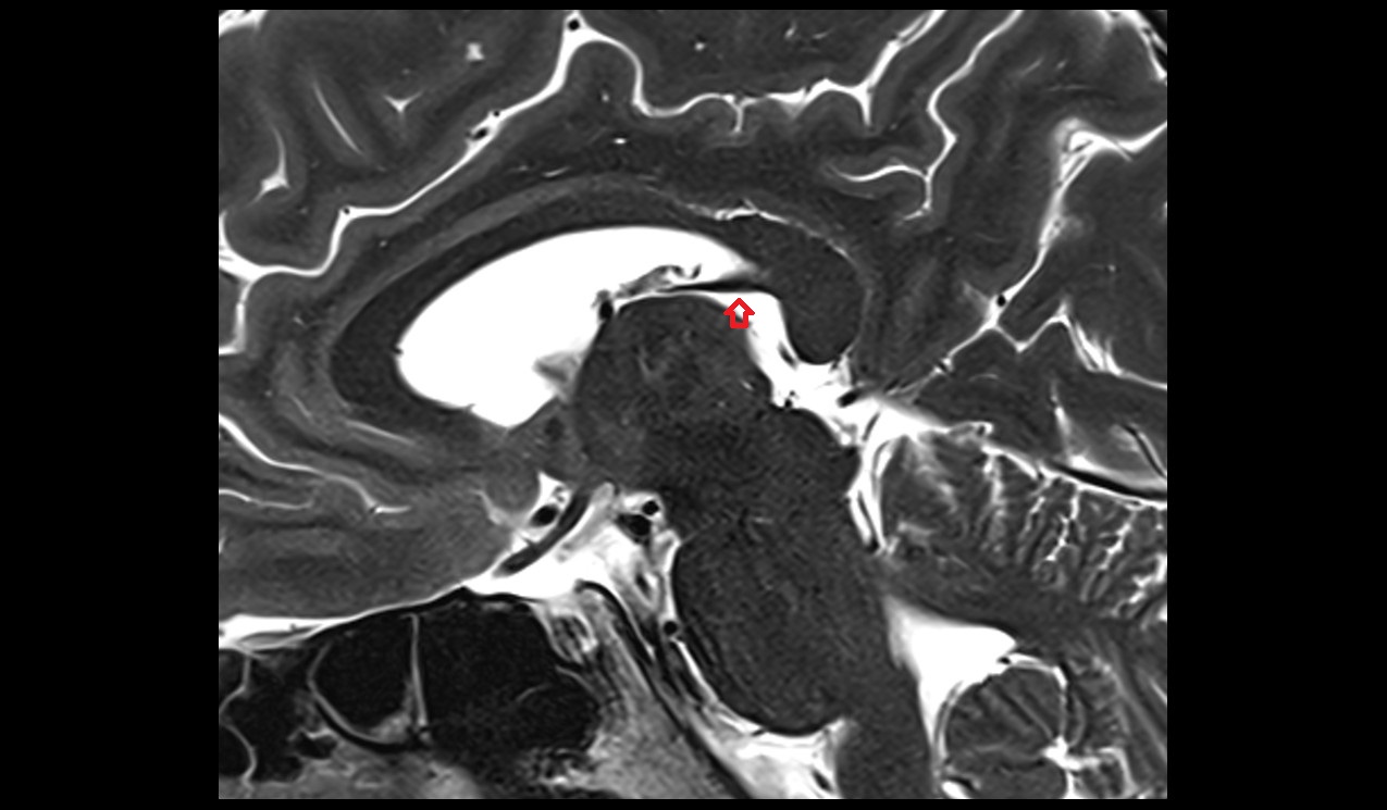 Cistern of transverse fissure mri 3t sagittal image