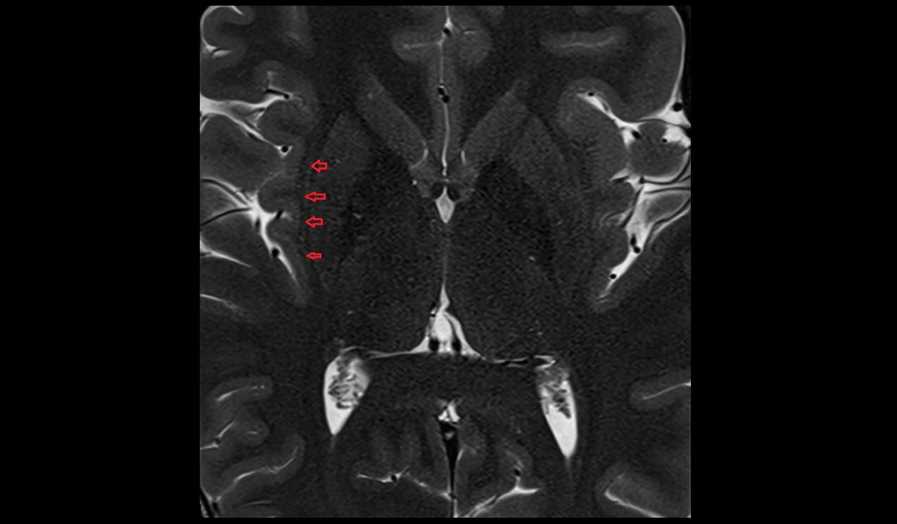 Claustrum mri 3t axial image