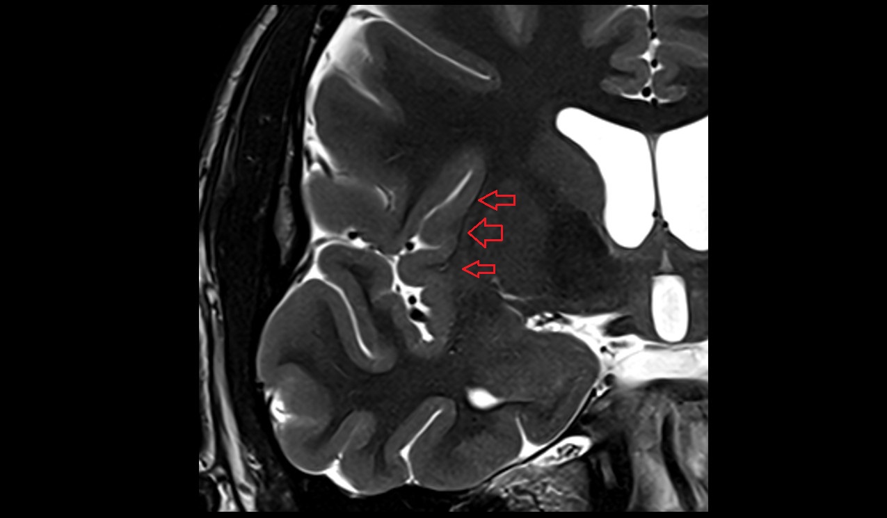 Claustrum mri 3t coronal image
