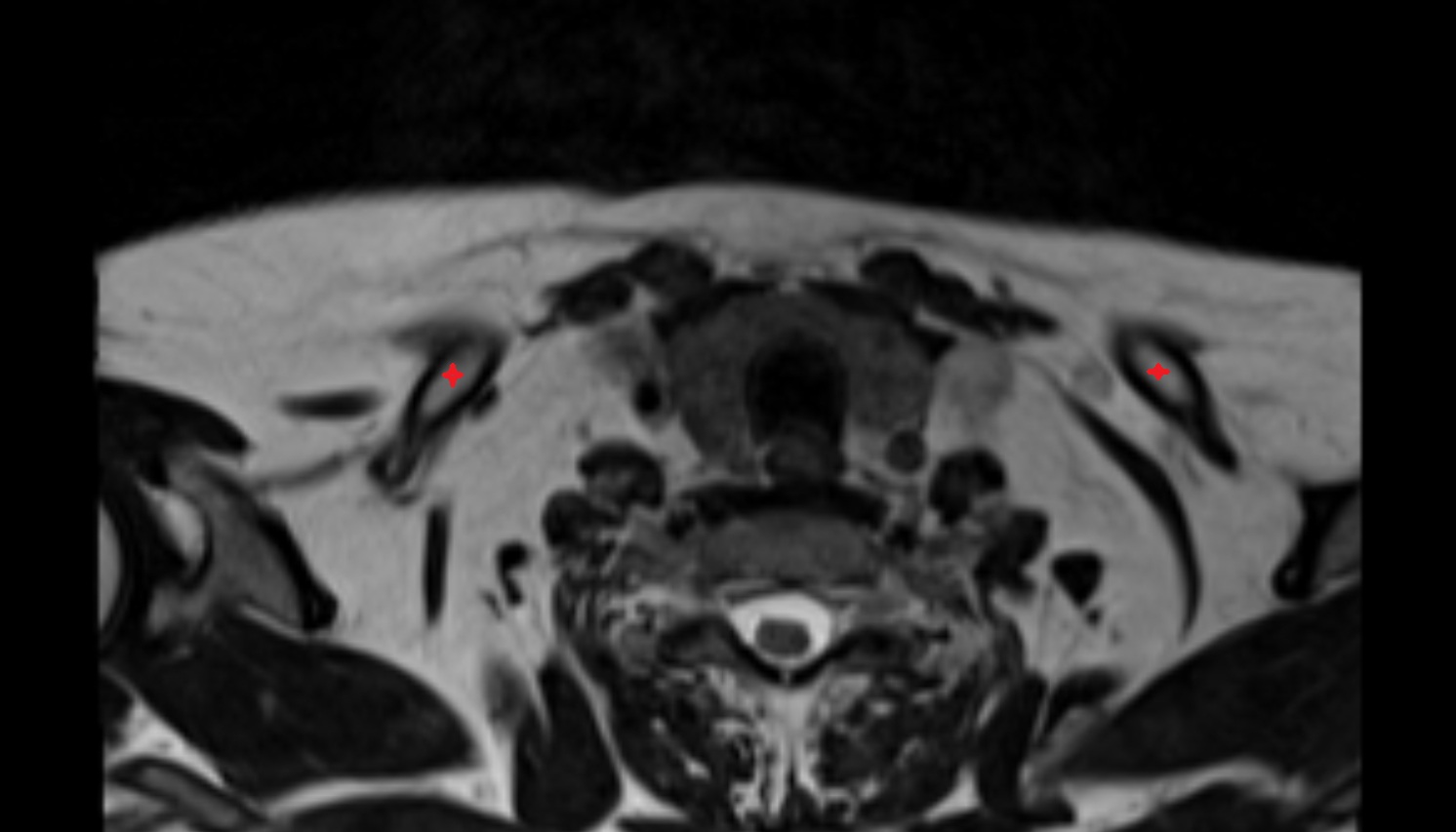 Clavicle mri axial image -img-00000-00000