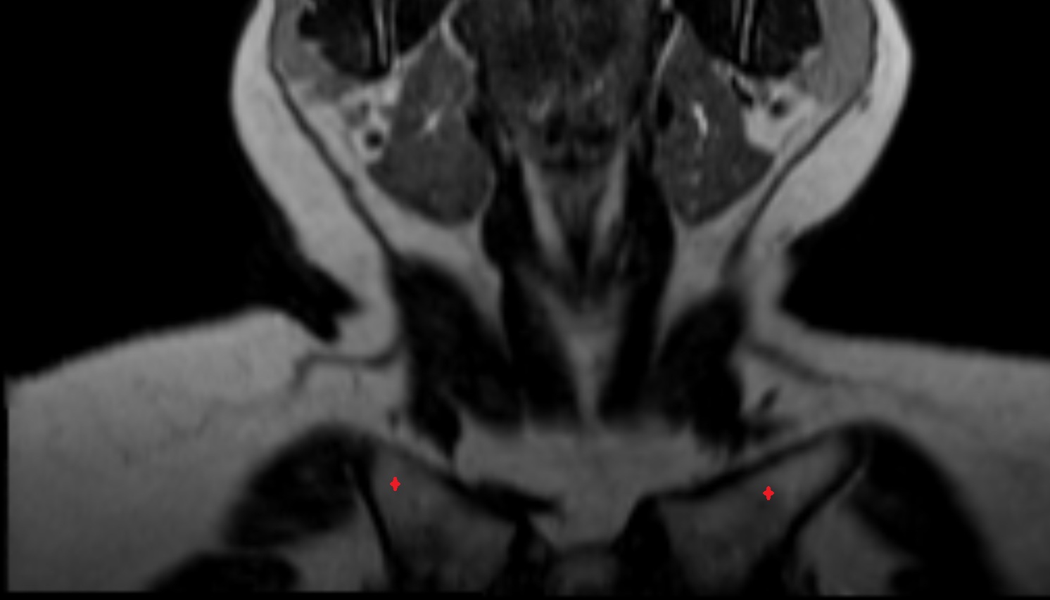 Clavicle mri coronal image -img-00000-00000