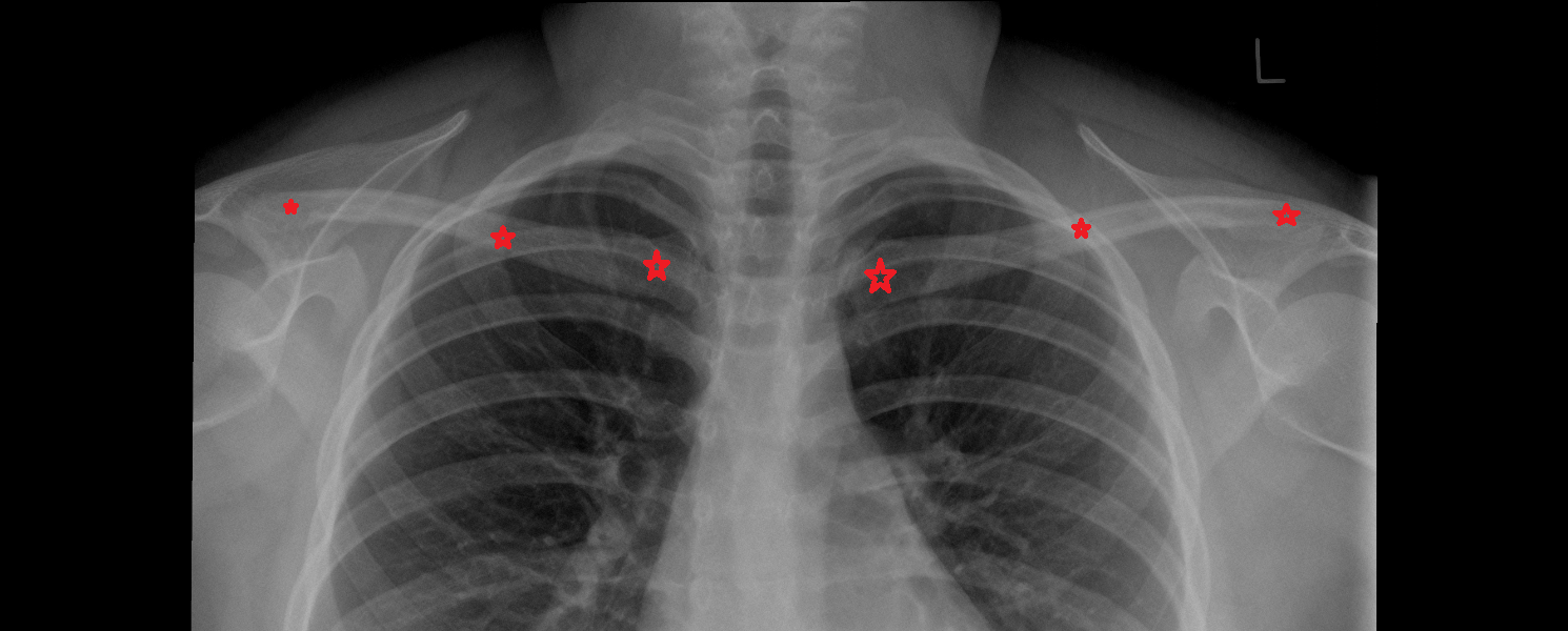 Clavicle x ray Anatomy, Location and Imaging Appearance  -img-00000-00000