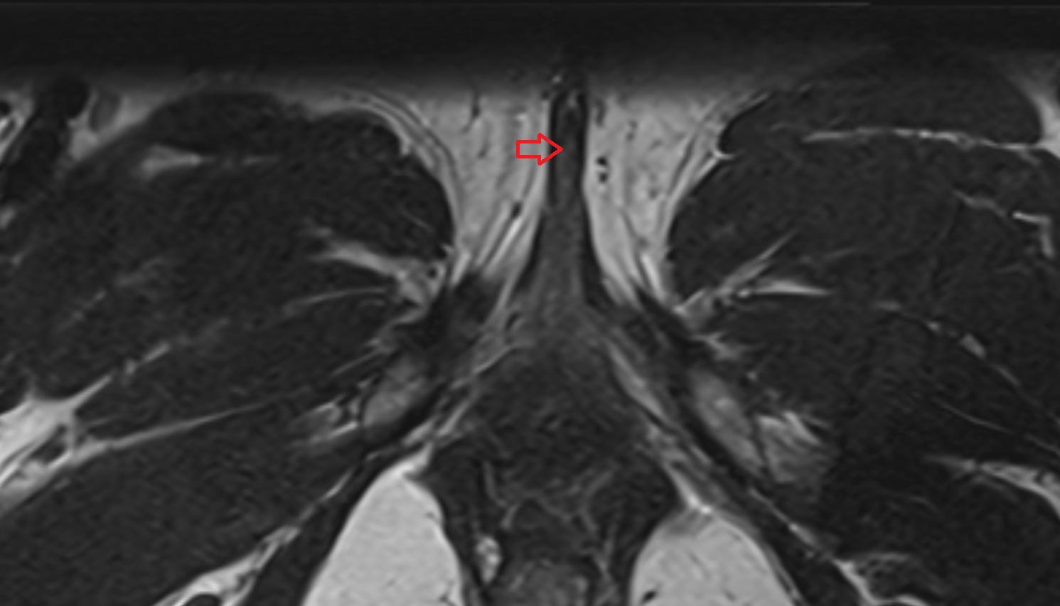Clitoris  MRI axial anatomy  image-img-00000-00000