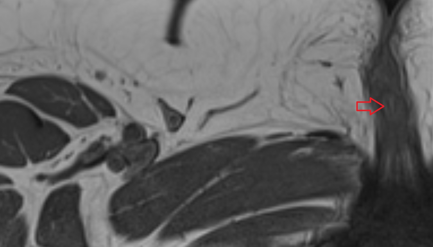 Clitoris  MRI axial anatomy  image-img-00000-00000_00001