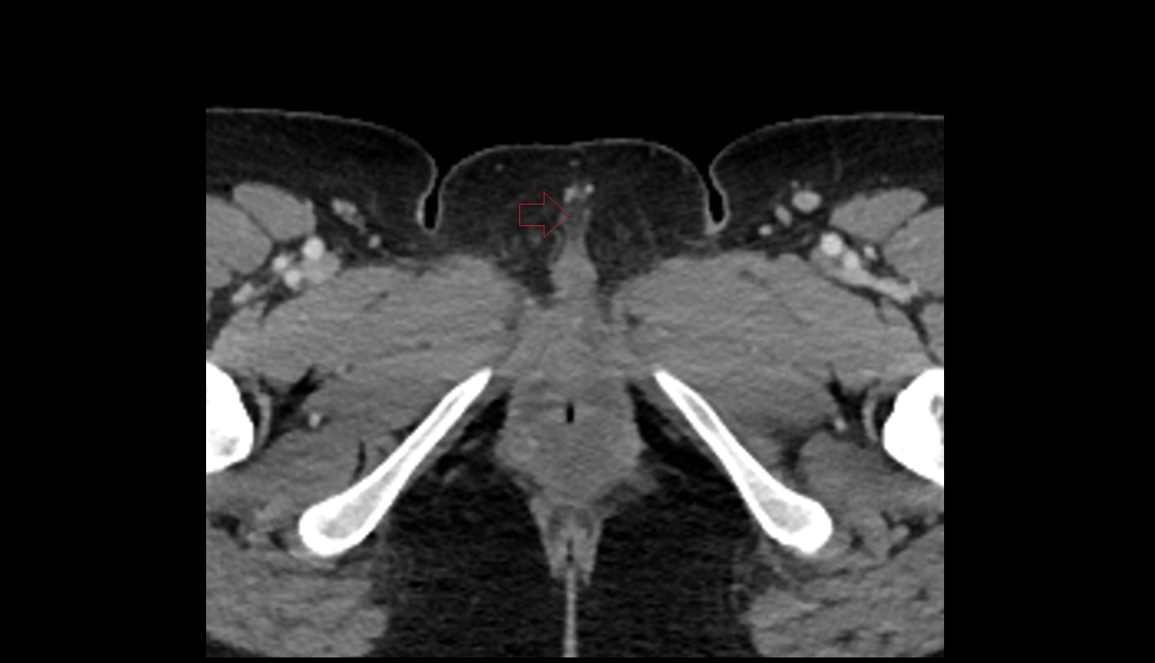 Clitoris ct axial image